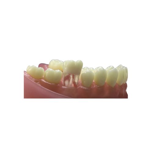 Dente 46 com Canal para Manequim de Dentística - Pronew