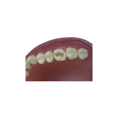 Dente 26 Classe I Oclusal para Manequim de Dentística - Pronew
